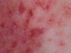 Couro Cabeludo Sensível? Pode ser mais sério do que parece.